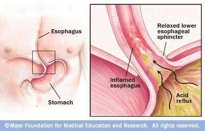 Acid Reflux Heartburn (acid reflux) is caused when acid washes up into the