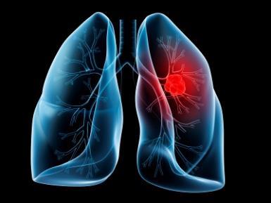 Background Lung cancer is the second most commonly diagnosed cancer in the US, with the highest mortality rate of all cancers.