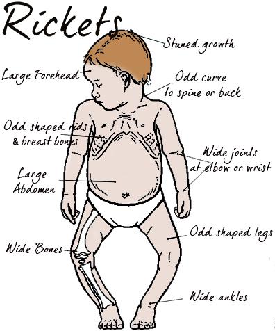Rickets Caused by