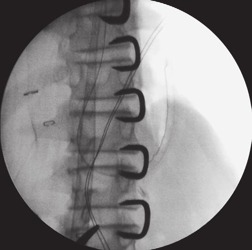 Lumbar Fusion Plate SMA Staples PURPOSE The Medtronic Sofamor Danek SPINAL STAPLE System is intended to be an implant system used for treatment of thoracic and/or lumbar scoliosis and other