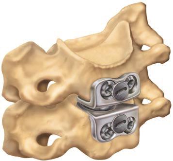 Cervical Disc PRESTIGE ST Cervical Disc DESCRIPTION The PRESTIGE Cervical Disc is a two-piece articulating metal-on-metal device that is inserted into the intervertebral disc space at a single