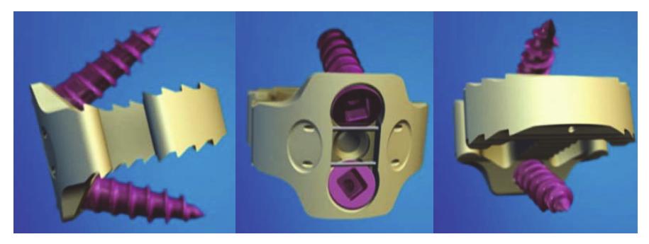 Cervical Interbody Fusion PEEK PREVAIL Cervical Interbody Device DESCRIPTION The PEEK PREVAIL Cervical Interbody Device is an intervertebral body fusion device with internal screw fixation.