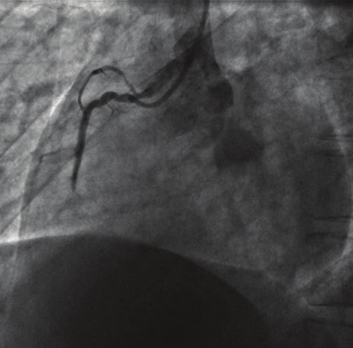 2 Case Reports in Medicine (a) (b) (c) (d) Figure 1: Initially, the coronary angiography showed an acute thrombotic occlusion on the second segment of the right coronary artery (Panel (a)).