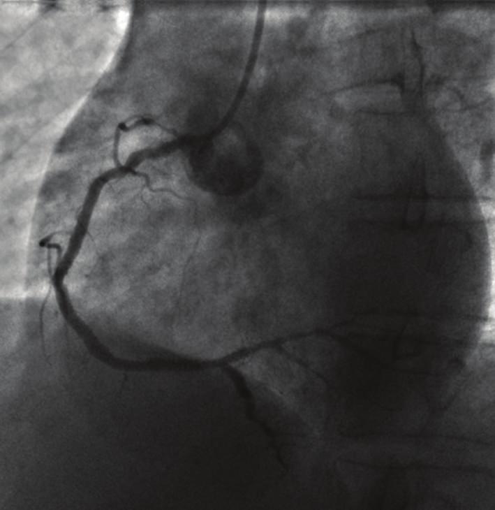 There were many diffuse lesions on the left anterior descending coronary artery and his branches without significant stenosis (Panel (d)). area and severe myocardial hypokinesia in the inferior wall.