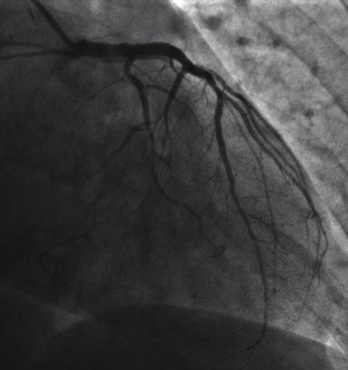 CMR detected transmural delayed enhancement in the inferior wall associated with late microvascular obstruction 10 minutes after gadolinium injection (Figure 2, Panel (f) and (g)).