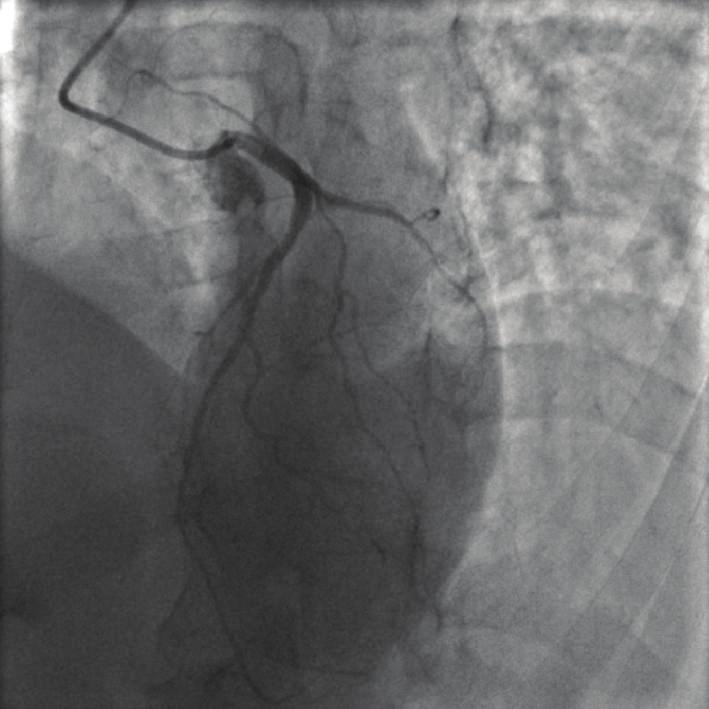 artery territory. The patient remained well and asymptomatic during follow-up. CMR and myocardial scintigraphy were also performed in this patient 3 months later.