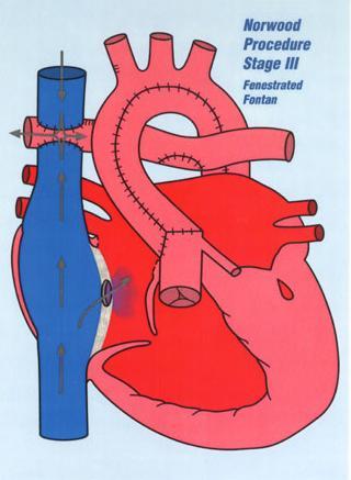 unloaded pumps blood only to body lungs receive passive systemic venous flow Pulmonary : Systemic blood flow Qp:Qs