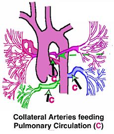 Major Aorta to Pulmonary Collateral Arteries (MAPCAs) CAUTION MAPCAs can be a few large vessels or a plexus of hundreds of small vessels.