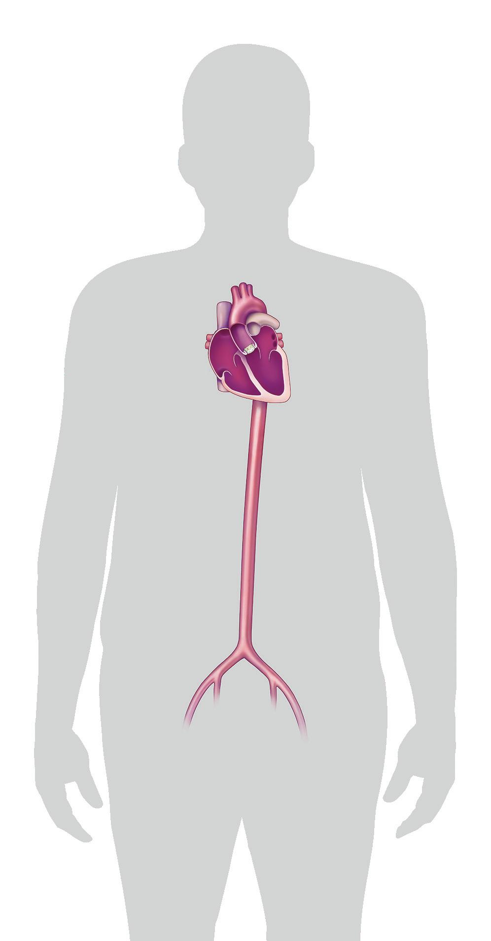 Transcatheter approach It is possible to replace the aortic valve using a catheter. This approach is called transcatheter aortic valve replacement (TAVR).