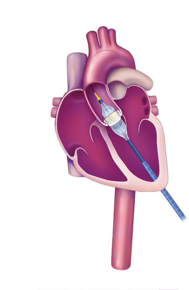 There are two types of heart valves used to replace diseased valves: Mechanical valves made from man-made material Tissue valves made mostly from animal