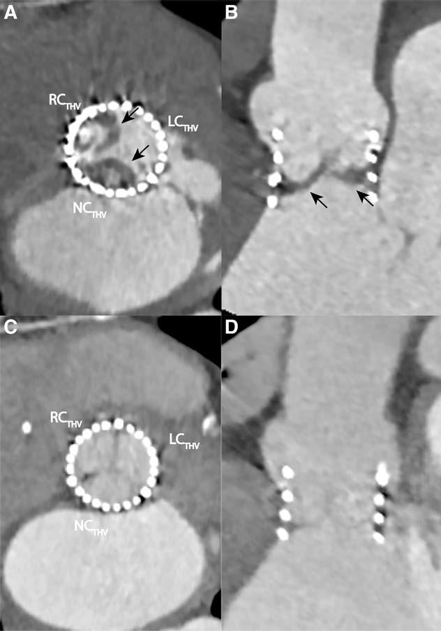 N = 140 5 (4%) THV thrombosis MDCT performed within 1-3 months of TAVI N = 1 heart failure symptoms N= 4 subclinical (asymptomatic) No neurological