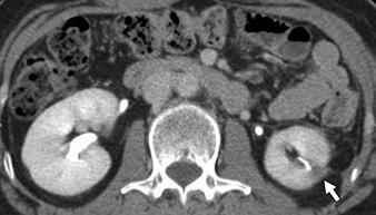 and C, On axial corticomedullary phase () and axial parenchymal phase (C) CT performed 3 months after