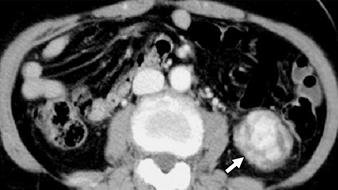 excision site (arrow) in left  D, On axial parenchymal phase CT performed 6 months after nephron-sparing