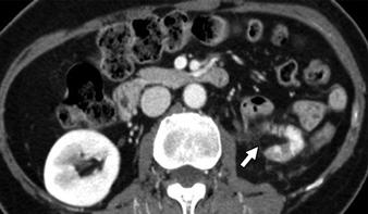 3 Fat at excision site in 53-year-old woman after left nephron-sparing surgery for renal cell , On