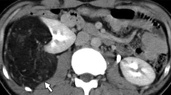corticomedullary phase CT performed 3 months after nephron-sparing surgery, low-density lesion with