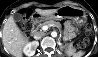 , On preoperative axial parenchymal phase CT, large fat-containing mass (arrow) is seen in right , On