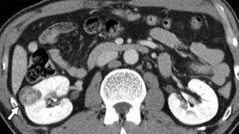 CT of Renal Tumors fter Nephron-Sparing Surgery Downloaded from www.ajronline.org by 148.251.232.