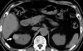 , On axial corticomedullary phase CT performed 3 months after nephron-sparing surgery, linear strands are seen