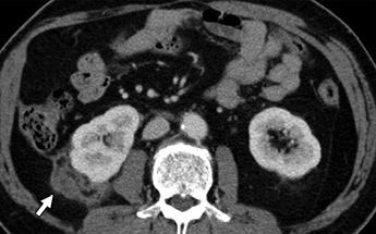 7 Mass-like lesion in retroperitoneal space in 65-year-old man after right nephron-sparing surgery for