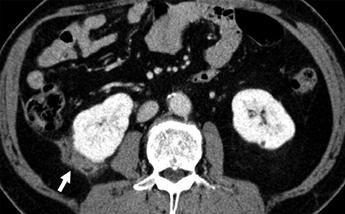 5-cm-diameter solid mass (arrow) is seen in right kidney.