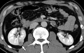 with soft-tissue density is seen in retroperitoneal space (arrow) with no enhancement or mass effect.
