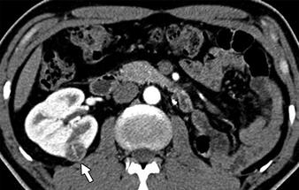 , On axial parenchymal phase CT performed 6 months after nephron-sparing surgery, soft-tissue-density lesion