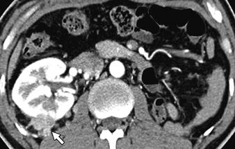 C, On axial parenchymal phase CT performed 2 years after nephron-sparing surgery, extent of mixture of