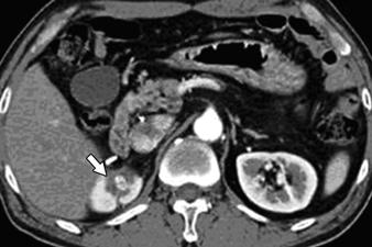 , On preoperative axial parenchymal phase CT, 1-cm-diameter solid mass (arrow) is seen in right kidney.