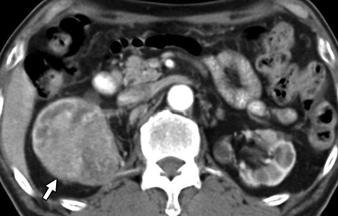 preoperative axial corticomedullary phase CT, 1- cm-diameter solid mass (arrow) is seen in right