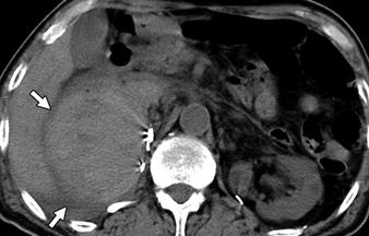 , On axial corticomedullary phase CT performed 3 months after nephron-sparing surgery, multiple