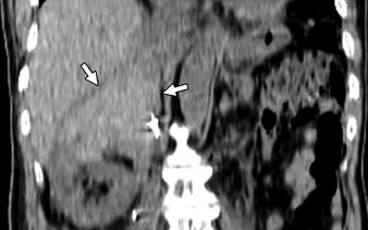 12 In 74-year-old man, hematoma as complication after right nephron-sparing surgery for  Gross
