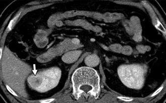 , On preoperative axial corticomedullary phase CT, large heterogeneously enhancing solid mass (arrow)