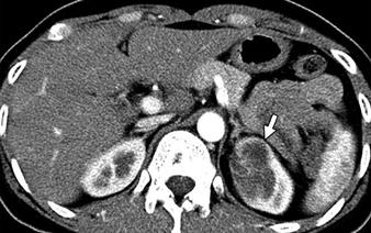 CT of Renal Tumors fter Nephron-Sparing Surgery Downloaded from www.ajronline.org by 148.251.232.83 on 04/26/18 from IP address 148.