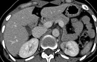 14 Ischemia as complication of nephron-sparing surgery in 39-year-old woman after left nephron-sparing surgery for cystic renal cell