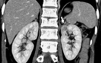 , On axial parenchymal phase CT performed 1 year after nephron-sparing surgery, parenchyma at surgical site shows decreased