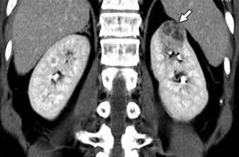 15 nother case of ischemia in 45-year-old man after right nephron-sparing surgery for renal cell carcinoma.