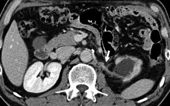 16 Ureteral or renal pedicle stricture as complication of nephron-sparing surgery in 55-year-old woman after left nephron-sparing
