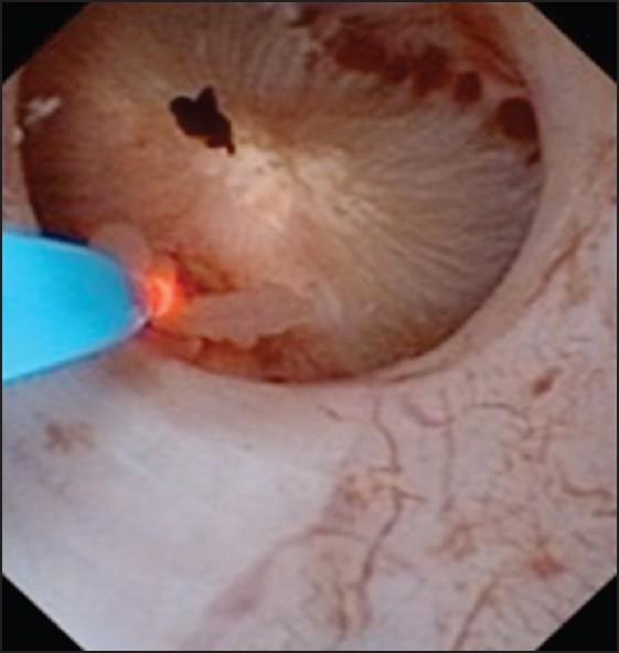 Ureteroscopy Preferred method Maintains closed system (low risk of seeding) Less invasive Technique Re-biopsy and debulk with graspers or