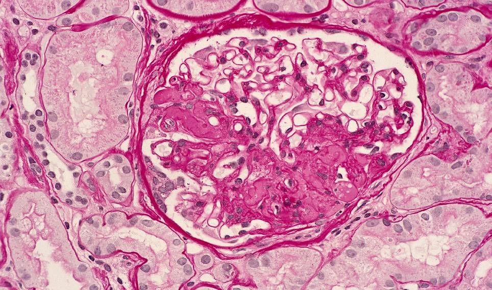 FOCAL SEGMENTAL GLOMERULOSCLEROSIS FSGS is the Most Common Cause of Nephrotic Syndrome in African American Adults Percent of Patients 70% 60% 50% 40% 30% 20% 10% 0% 20% 14% 57% 23% 24% 36% 6% 2%