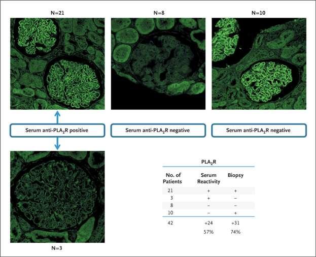 Correlation between Circulating PLA 2 R Autoantibodies and PLA 2 R Glomerular Deposits.