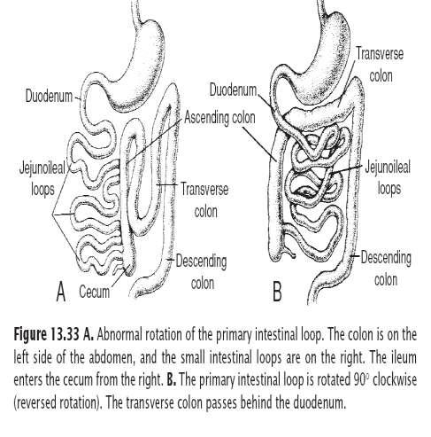 Reversed rotation of the intestinal loop occurs when the primary loop rotates 90 clockwise In this abnormality the transverse colon passes behind the duodenum and lies behind the superior mesenteric