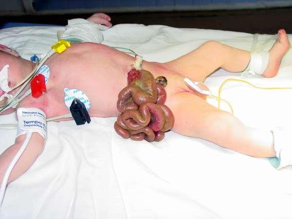 Gastroschisis is a herniation of abdominal contents through the body wall