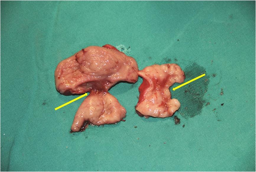 Chen et al. BMC Gastroenterology 2014, 14:108 Page 4 of 5 Figure 4 Case 3. Examination of the surgical specimens revealed 2 areas of diaphragm-like tissue.