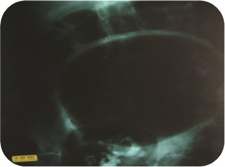 2 Case Reports in Medicine Figure 1: Abdominal X-ray showing air fluid level with a dilated loop of sigmoid colon.