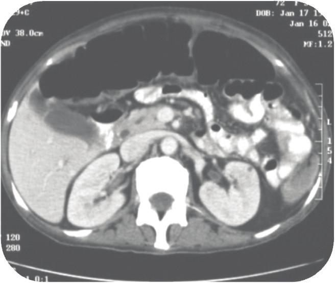 that a ball-valve/flap-valve mechanism is created whereby gas can enter the serosa-lined cyst as intraluminal pressure increases but cannot exit the diverticulum (a one-way communicating stalk) [1, 7