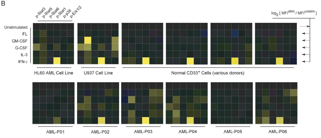 Figure 1B: Individual AML patients display unique signaling profiles HL60: acute promyelocytic leukemia (APML)