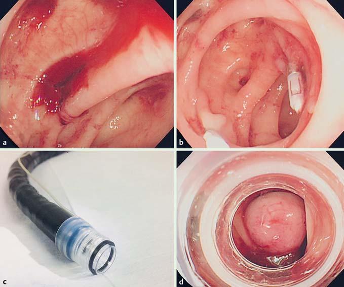 E235 Fig. 2 a Endoscopic view of colonic diverticulum with active bleeding. b Marking with hemoclips near the diverticulum.