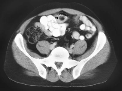 Companion patient 3: Intussusception of Meckel s on CT Scan Meckel s telescoped into normal bowel Ring of mesenteric fat Turkington JR, Devlin PB, Dace S,
