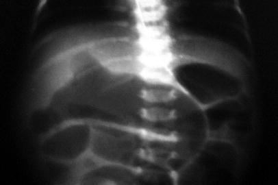 Abdominal Plain Film and Companion Patient 4 Poor sensitivity Radiographic signs are nonspecific: Intestinal obstruction Enterolith Air/fluid levels Outpouching suggestive of Meckel s