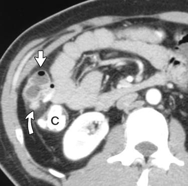 CT and Companion Patient 6 and 7 Non-specific findings unless attached to umbilicus or there is complication